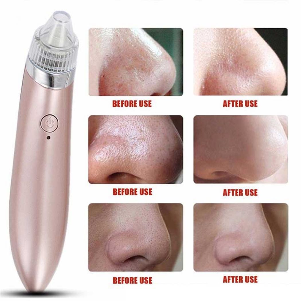 1 Electric Vacuum Pore Cleaner Spot Acne Blackhead Remover in Pakistan